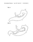 APPARATUS FOR TREATING OBESITY BY EXTRACTING FOOD diagram and image