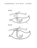 APPARATUS FOR TREATING OBESITY BY EXTRACTING FOOD diagram and image