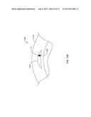 CRESCENT CHANNEL DYE FLOW ENABLED GUIDE CATHETERS diagram and image