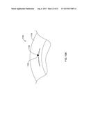 CRESCENT CHANNEL DYE FLOW ENABLED GUIDE CATHETERS diagram and image