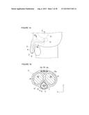 URETHRAL STRICTURE TREATMENT METHOD diagram and image