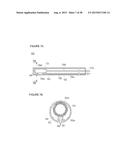 URETHRAL STRICTURE TREATMENT METHOD diagram and image