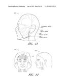 ENERGY-BASED TISSUE TIGHTENING SYSTEM diagram and image