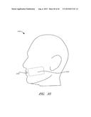 ENERGY-BASED TISSUE TIGHTENING SYSTEM diagram and image