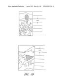 ENERGY-BASED TISSUE TIGHTENING SYSTEM diagram and image