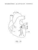 IMPLANTABLE ECHO DOPPLER FLOW SENSOR FOR MONITORING OF HEMODYNAMICS diagram and image