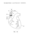 IMPLANTABLE ECHO DOPPLER FLOW SENSOR FOR MONITORING OF HEMODYNAMICS diagram and image