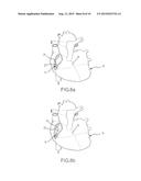 Contact sensor and sheath exit sensor diagram and image