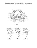 IMPLANT SYSTEM AND METHOD FOR STABILIZATION OF A SACRO-ILIAC JOINT diagram and image