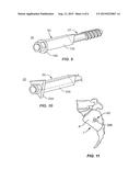 IMPLANT SYSTEM AND METHOD FOR STABILIZATION OF A SACRO-ILIAC JOINT diagram and image