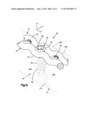 BONE FIXATION SYSTEM diagram and image