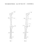 ADJUSTABLE DEVICES FOR TREATING ARTHRITIS OF THE KNEE diagram and image