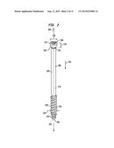 INTRAMEDULLARY FIXATION ASSEMBLY AND METHOD OF USE diagram and image