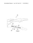 INTRAMEDULLARY FIXATION ASSEMBLY AND METHOD OF USE diagram and image