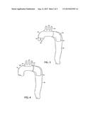 AORTIC GRAFT DEVICE diagram and image