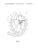 PERCUTANEOUS TRANSVALVULAR INTRAANNULAR BAND FOR MITRAL VALVE REPAIR diagram and image