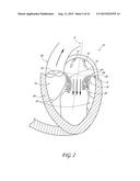 PERCUTANEOUS TRANSVALVULAR INTRAANNULAR BAND FOR MITRAL VALVE REPAIR diagram and image