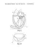 PERCUTANEOUS TRANSVALVULAR INTRAANNULAR BAND FOR MITRAL VALVE REPAIR diagram and image