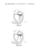 PERCUTANEOUS TRANSVALVULAR INTRAANNULAR BAND FOR MITRAL VALVE REPAIR diagram and image