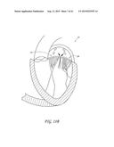 PERCUTANEOUS TRANSVALVULAR INTRAANNULAR BAND FOR MITRAL VALVE REPAIR diagram and image