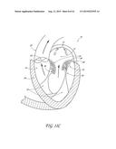 PERCUTANEOUS TRANSVALVULAR INTRAANNULAR BAND FOR MITRAL VALVE REPAIR diagram and image