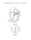 PERCUTANEOUS TRANSVALVULAR INTRAANNULAR BAND FOR MITRAL VALVE REPAIR diagram and image