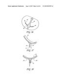 PERCUTANEOUS TRANSVALVULAR INTRAANNULAR BAND FOR MITRAL VALVE REPAIR diagram and image