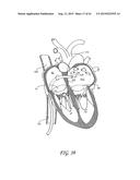 PERCUTANEOUS TRANSVALVULAR INTRAANNULAR BAND FOR MITRAL VALVE REPAIR diagram and image