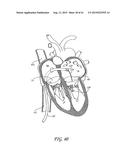 PERCUTANEOUS TRANSVALVULAR INTRAANNULAR BAND FOR MITRAL VALVE REPAIR diagram and image