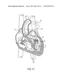 PERCUTANEOUS TRANSVALVULAR INTRAANNULAR BAND FOR MITRAL VALVE REPAIR diagram and image