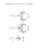 PERCUTANEOUS TRANSVALVULAR INTRAANNULAR BAND FOR MITRAL VALVE REPAIR diagram and image