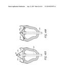 PERCUTANEOUS TRANSVALVULAR INTRAANNULAR BAND FOR MITRAL VALVE REPAIR diagram and image