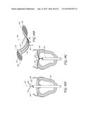 PERCUTANEOUS TRANSVALVULAR INTRAANNULAR BAND FOR MITRAL VALVE REPAIR diagram and image