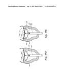 PERCUTANEOUS TRANSVALVULAR INTRAANNULAR BAND FOR MITRAL VALVE REPAIR diagram and image