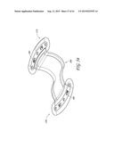 PERCUTANEOUS TRANSVALVULAR INTRAANNULAR BAND FOR MITRAL VALVE REPAIR diagram and image