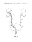 TELESCOPING URETERAL STENT diagram and image