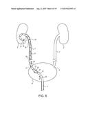 TELESCOPING URETERAL STENT diagram and image