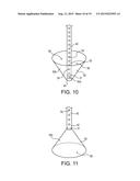 TELESCOPING URETERAL STENT diagram and image