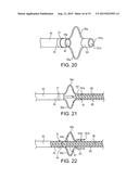 TELESCOPING URETERAL STENT diagram and image