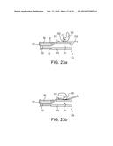 TELESCOPING URETERAL STENT diagram and image