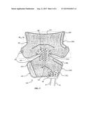 THERAPEUTIC WRAP WITH PATTERN ZONE diagram and image