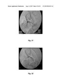 RESORBABLE OXIDIZED CELLULOSE EMBOLIZATION SOLUTION diagram and image