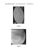 RESORBABLE OXIDIZED CELLULOSE EMBOLIZATION SOLUTION diagram and image