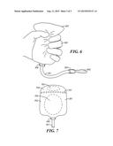 Method and Apparatus for a Squeezable Food Container Having a Direct     Feeding Tube Connector diagram and image