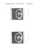 SURGICAL ASSISTANCE PLANNING METHOD USING LUNG MOTION ANALYSIS diagram and image