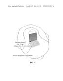 PIXEL ARRAY MEDICAL DEVICES AND METHODS diagram and image