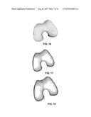 PERSONALIZED ORTHOPEDIC IMPLANT CAD MODEL GENERATION diagram and image