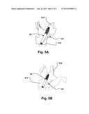 MEDICAL IMPLANT AND METHOD OF IMPLANTATION diagram and image