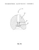 DENTURE REFERENCE AND REGISTRATION SYSTEM diagram and image