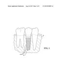 FLUTED OSTEOTOME AND SURGICAL METHOD FOR USE diagram and image